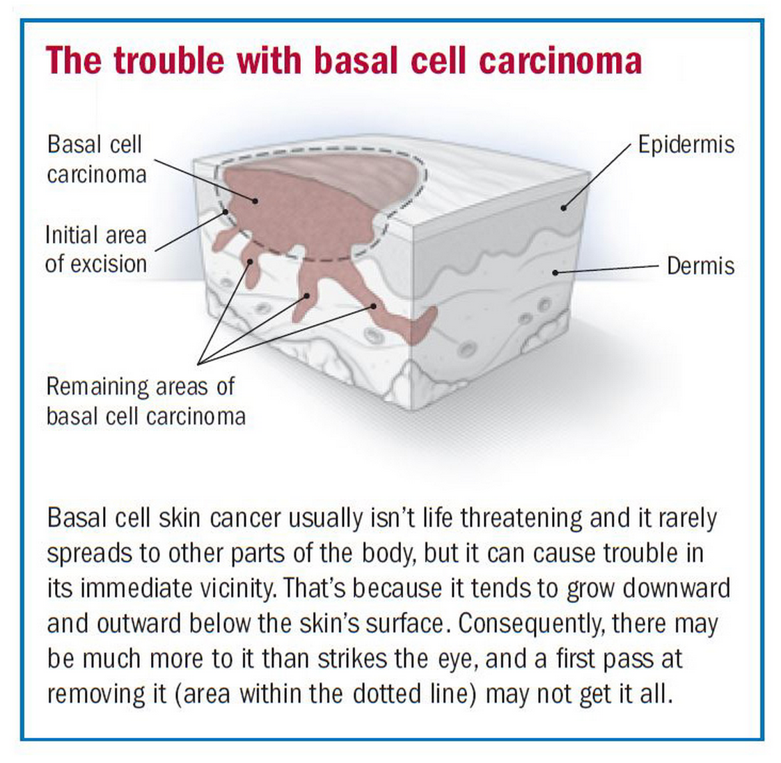 Basal Cell Carcinoma Utah County | Dr. David Myers