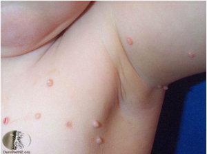 Rosefarve Gendanne Problem Tiny Bumps On My Child's Skin: What Is It? - Utah Valley Dermatology