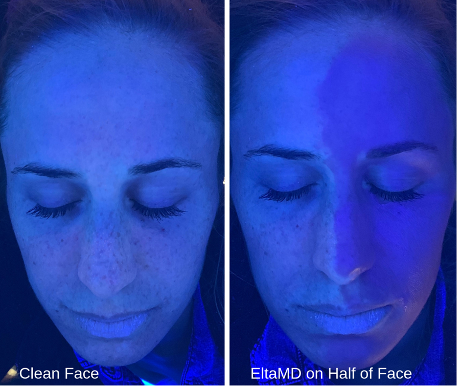 EltaMD on Half of Face Comparison - Skin Cancer Awareness Month
