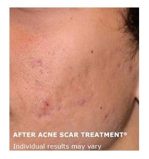 acne scar treatment ba1a
