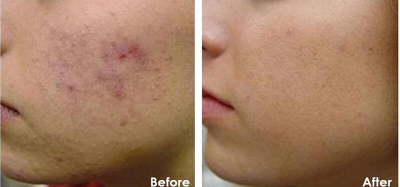 chemical peel before and after 1