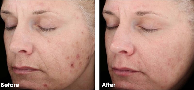 chemical peel before and after 4