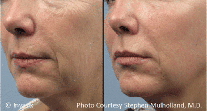 prp injections and treatments for the face in utah