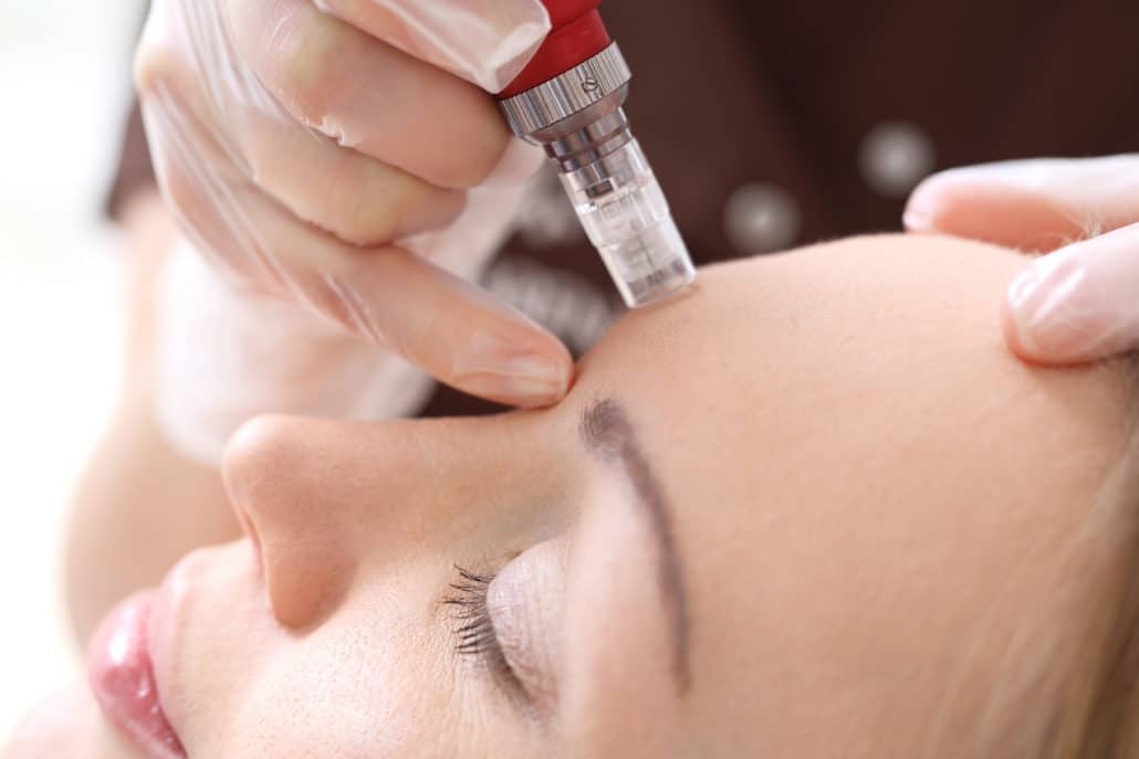an image of a woman with her eyes closed recieving a microneedling treatment.