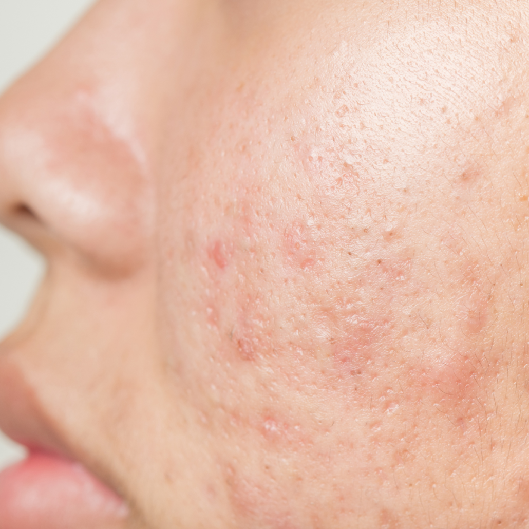 acne scarring on cheek