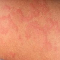 shingles herpes zoster 300x199