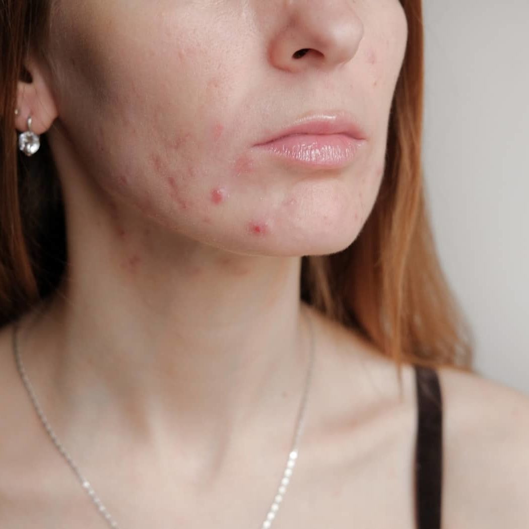 woman with problem skin teen acne on young skin tools for removing picture id1167910623
